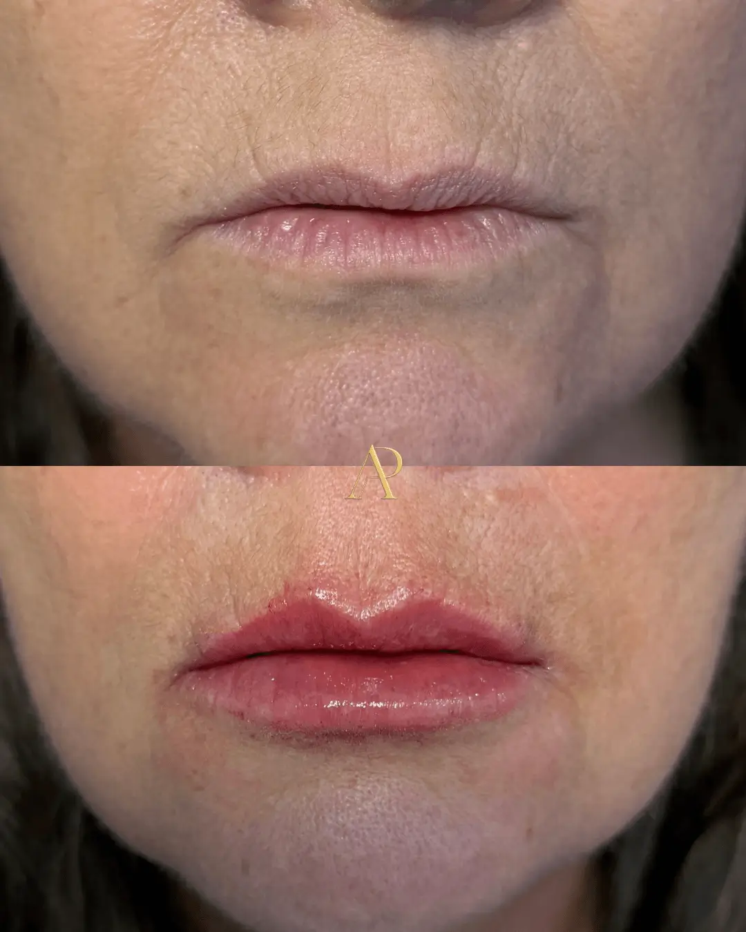 Resultado de harmonização facial — antes e depois 2
