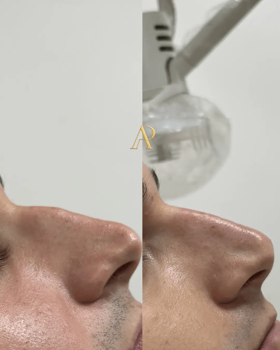 Resultado de harmonização facial — antes e depois 6