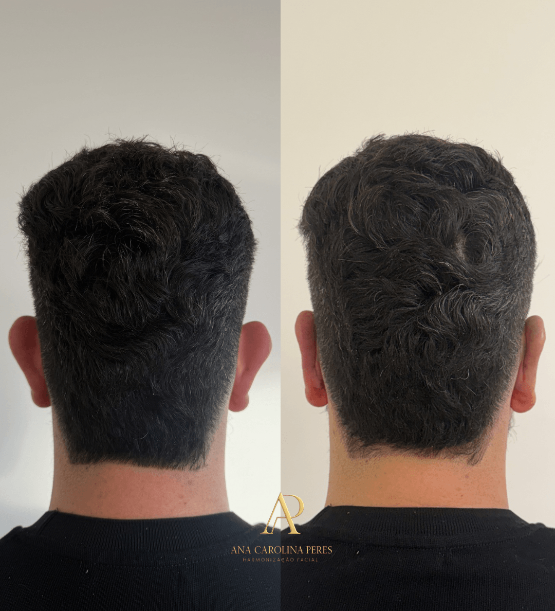Resultado de otomodelação Método CDT — orelha reposicionada de forma natural
